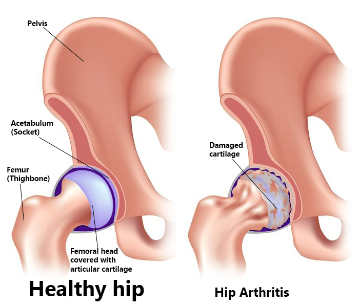 hip-arthritis
