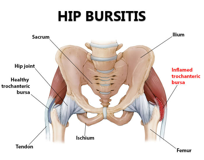 hip bursitis