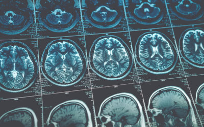 Do I Have a Brain Tumor: Signs and Symptoms