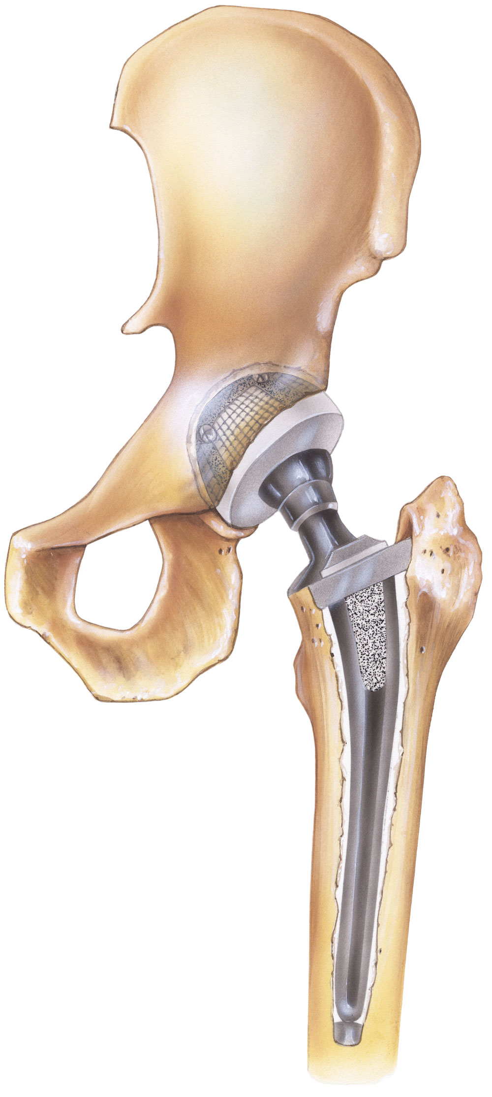 total-hip-replacement