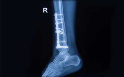 Closed Fracture Treatment