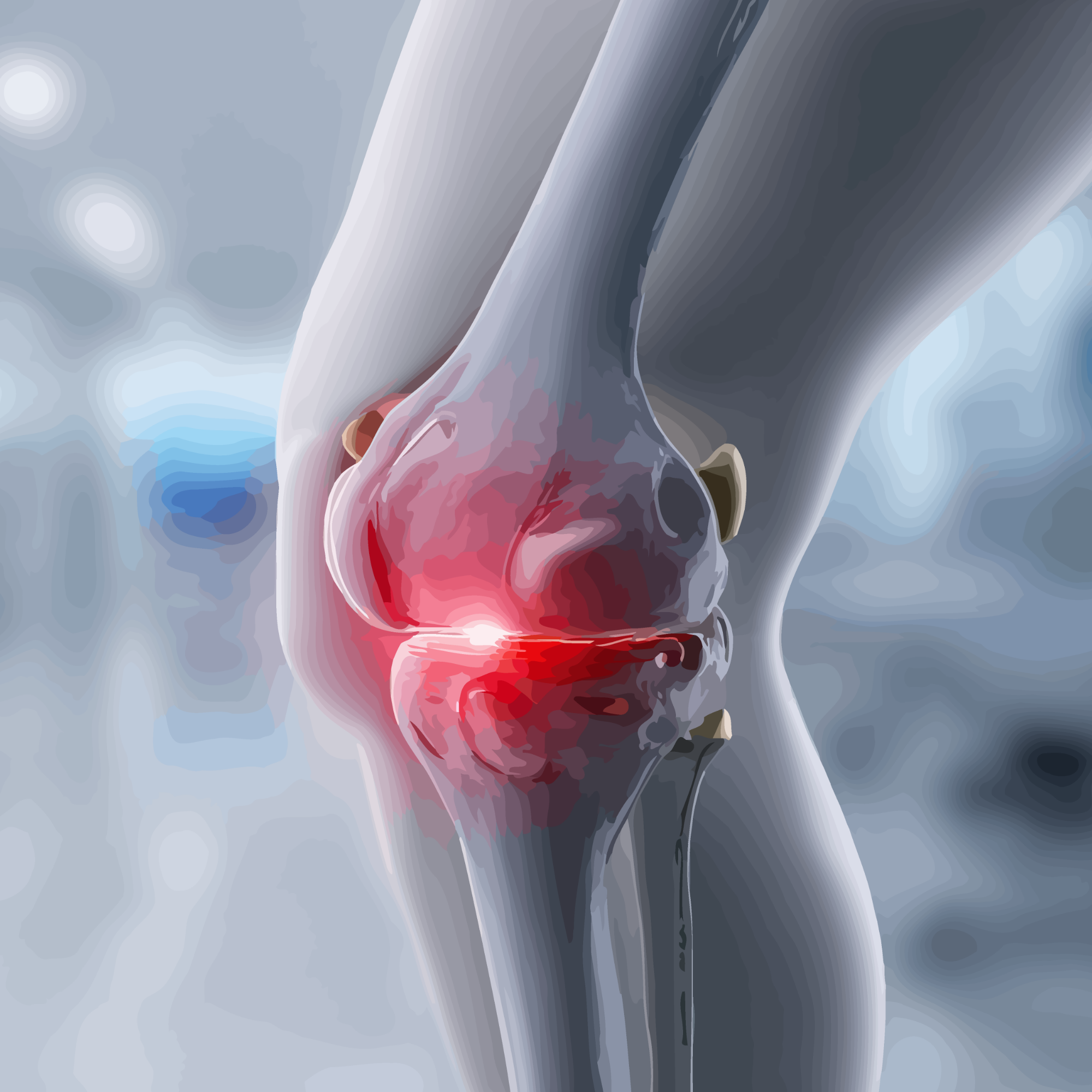 joint replacement