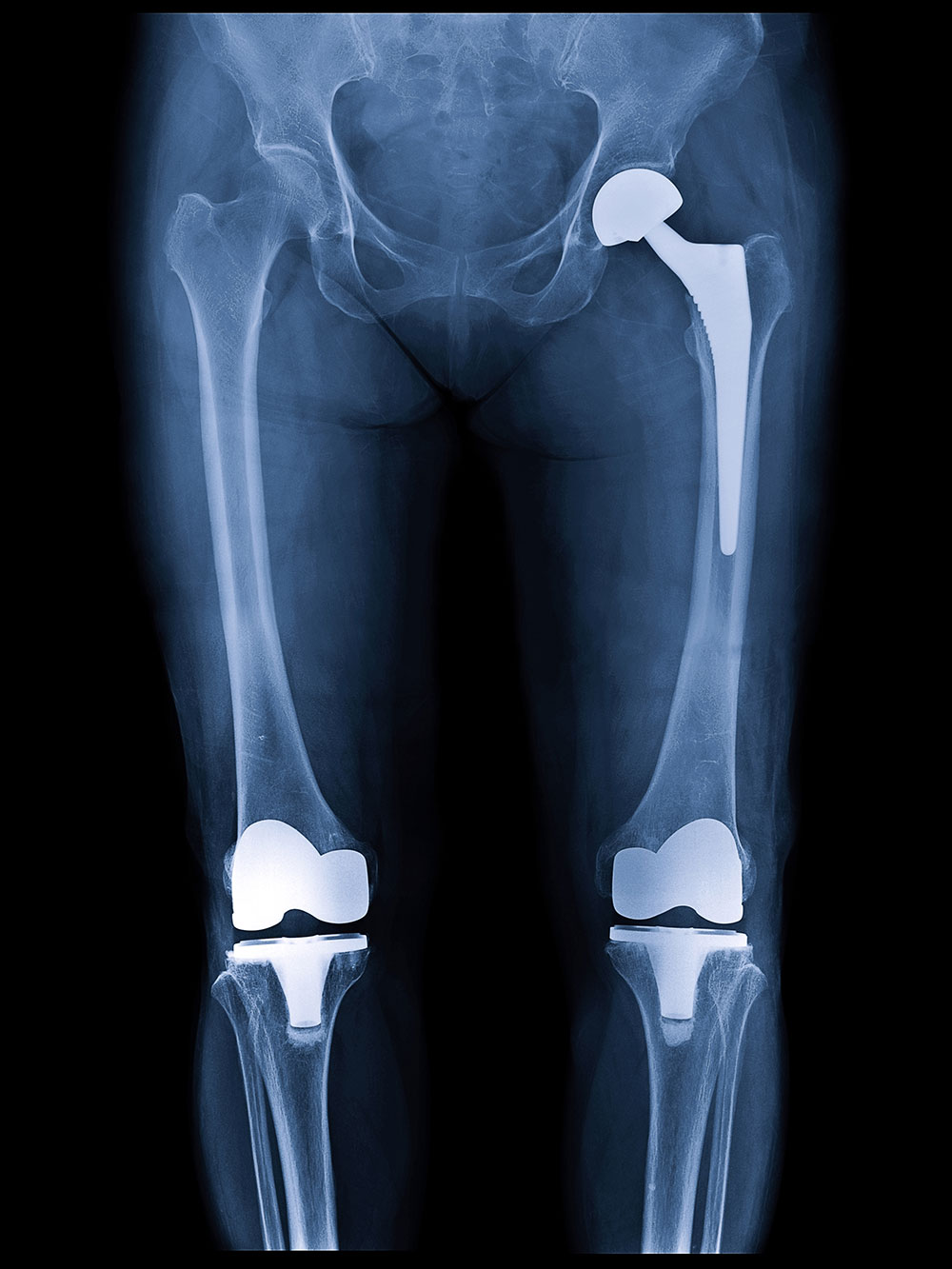 hip-knee-arthroplasty